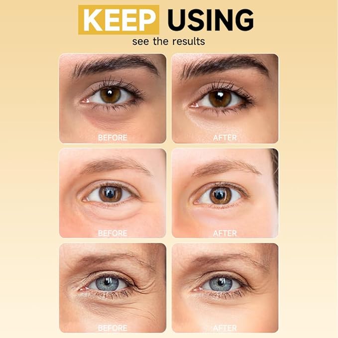 8 Pairs 5% PDRN Under Eye Patches, 6-in-1 Bio-Collagen 360° Eye Patches for puffy eyes, dark circles & Wrinkle | 2% Caffeine, Kojic acid, Retinol, Hyaluronic, Niacinamide | Korean Popular Eye Mask