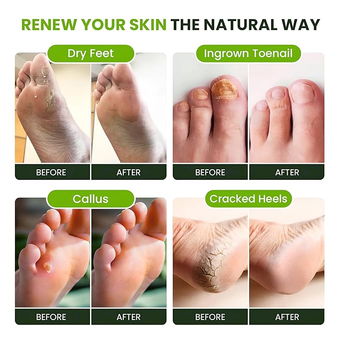 FOOT CURE Tea Tree Oil Foot Soak with Epsom Salt - Best Toenail Fungus Treatment, Athletes Foot & Softens Calluses - Soothes Sore & Tired Feet, Fungal Toe, Foot Odor Scent, Spa Pedicure (Pack of 2) | Tea Tree Oil, with Epsom Salt, Fungal Toe, Foot Odor...