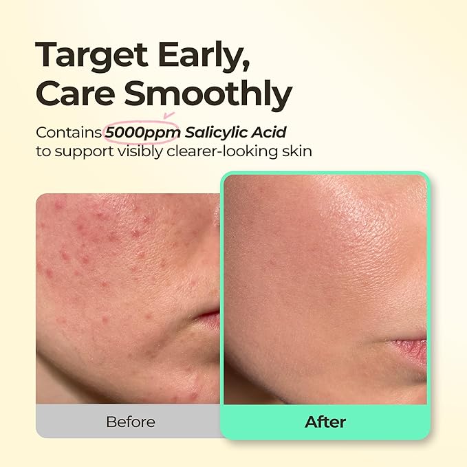 SINSURU BHA Iconic Spot Patch with Mirror Case - Hydrocolloid Patches with 5,000ppm Salicylic Acid - Day & Night Zit Patch for Targeted Sebum Care & Stylish Wear