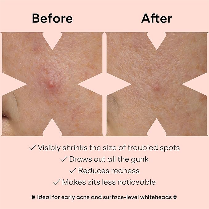 ZVYK Pimple Patches Cute for Face (28 Unique Acne Patch Designs) | Hydrocolloid, Salicylic Acid, Tea Tree | Strong Adhesion, Waterproof, Vegan | Confidence Patch Be You