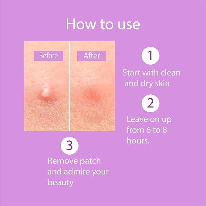 Wali Acne Patch with Tea Tree and Hydrocolloid, 72 Patches, 8mm and 12mm Sizes, Gentle for All Skin Types, Absorbs Secretions