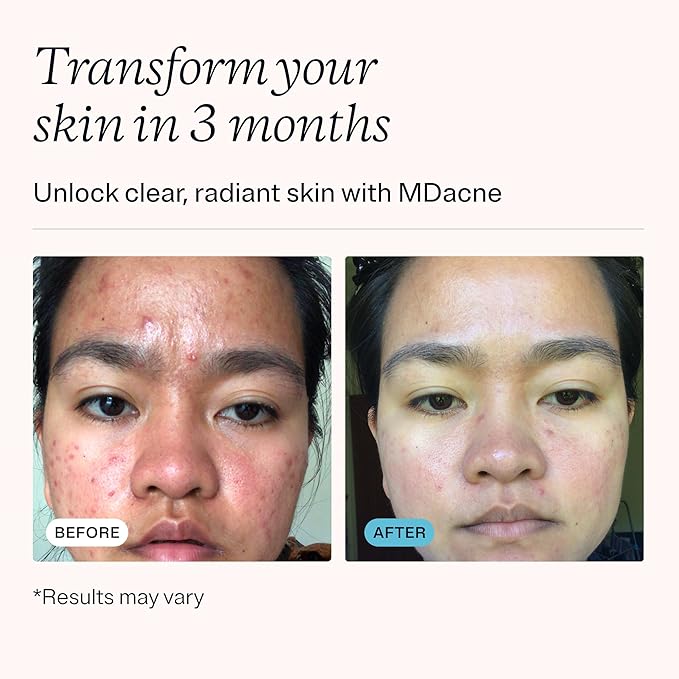 MDacne 3 Step Face Acne Treatment Kit, Benzoyl Peroxide Cream 2.5%, Salicylic Acid Cleanser, Niacinamide Moisturizer – Medicated Plant-Based Skincare for Adult & Teen Acne, 30 Day Kit