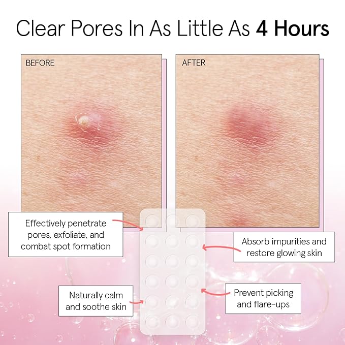 grace & stella Award Winning Multi-Size Pimple Patches for Face - Dermatologist Tested Acne Patches for Face - Hydrocolloid Patch for Breakouts, Whiteheads - Vegan Pimple Patch (Clear, 36 Pack)