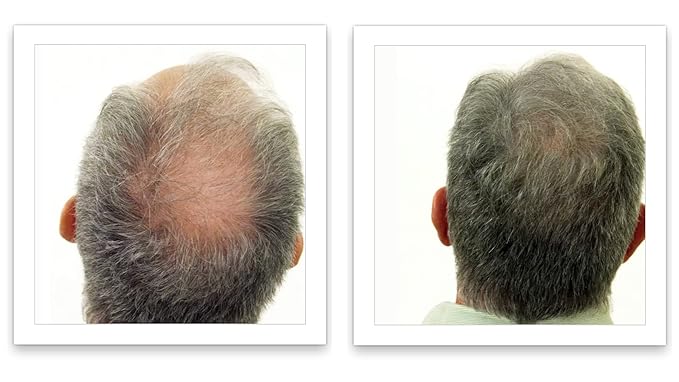 Caboki Hair Loss Concealer. All-Natural Hair Building Fiber. Make Thin Hair Look 10X Fuller Instantly. Eliminate the Appearance of Bald Spot and Thinning Hair (30G, 90-Day Supply).Salt & Pepper-Light