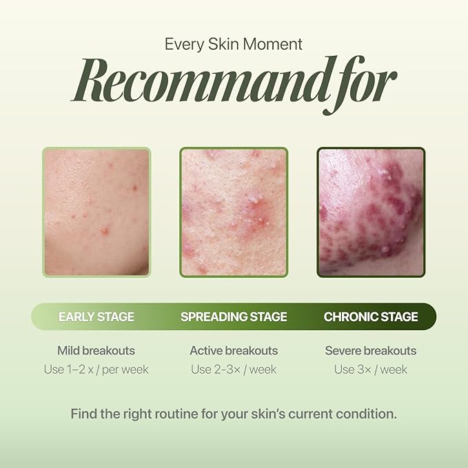 EIOM Trouble Patch Mask | Full-Face Acne Sheet Mask for Acne-Prone & Oily Skin – Blemish & Sebum Control Mask with Tea Tree Biome | Korean Skincare, 20ml x 4