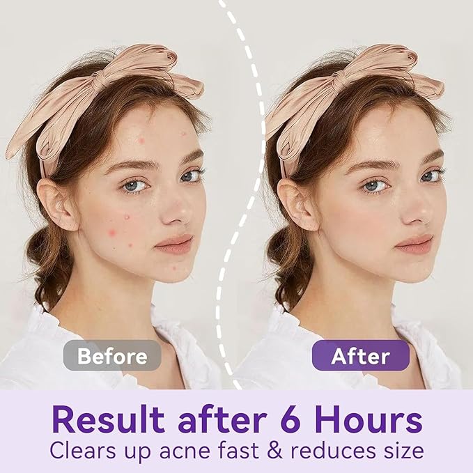 OmaDoto Overnight Pimple Patches for Face -（10mm & 12mm | 72 Count | 6 Sheets） - Hydrocolloid Patches with Salicylic Acid, Long-Wear Zit Stickers for Teens & Adults, Day & Night Use