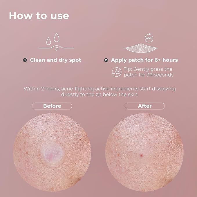 OMMA Korean Microdart Acne Patch, Cystic Acne Treatment, Micropoint Pimple Patches for Face for Early-Stage Painful Zits, Salicylic Acid & Tea Tree - 17 mm Zit Stickers (18 Count)