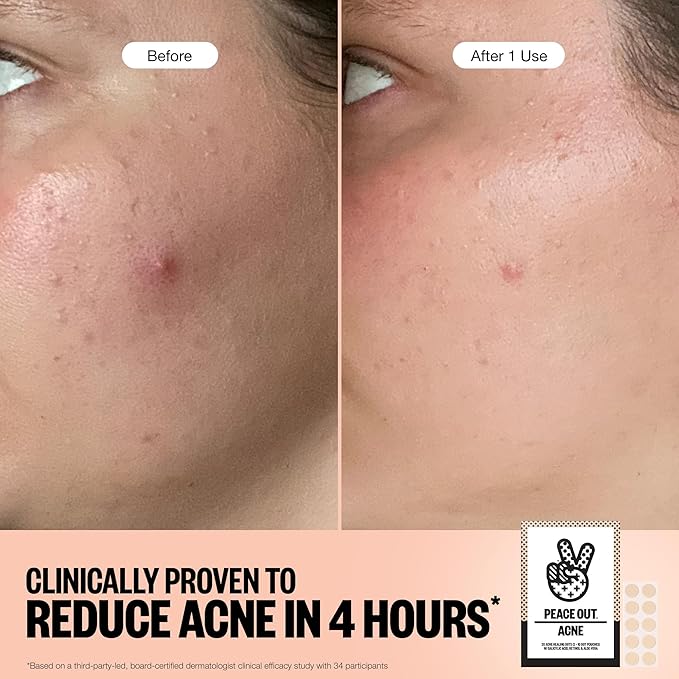 PEACE OUT Acne Healing Dots Hydrocolloid Pimple Patches, Acne Spot Patches with Salicylic Acid, Retinol, and Aloe Vera for Blemishes and Breakouts, 40 Count
