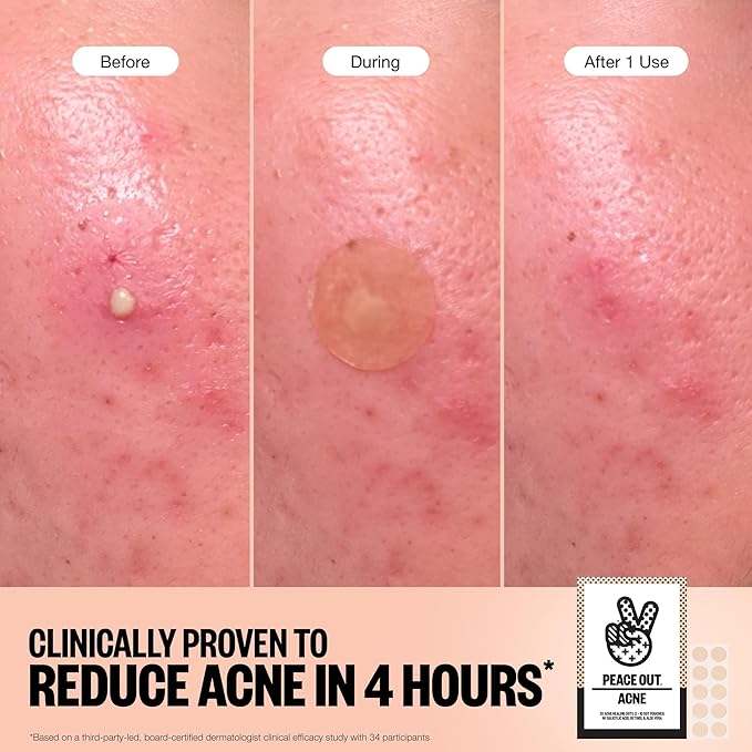 PEACE OUT Acne Healing Dots Hydrocolloid Pimple Patches, Acne Spot Patches with Salicylic Acid, Retinol, and Aloe Vera for Blemishes and Breakouts, 20 Count
