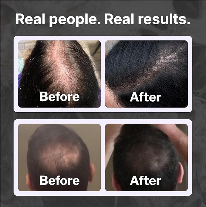 Shapiro MD Hair Growth Experts Natural Hair Kit for Thicker, Fuller, Healthier Looking Hair - Including Shampoo, Conditioner and Leave-In Daily Foam (1 Month Supply) | Hair Growth Experts, Thicker, Fuller