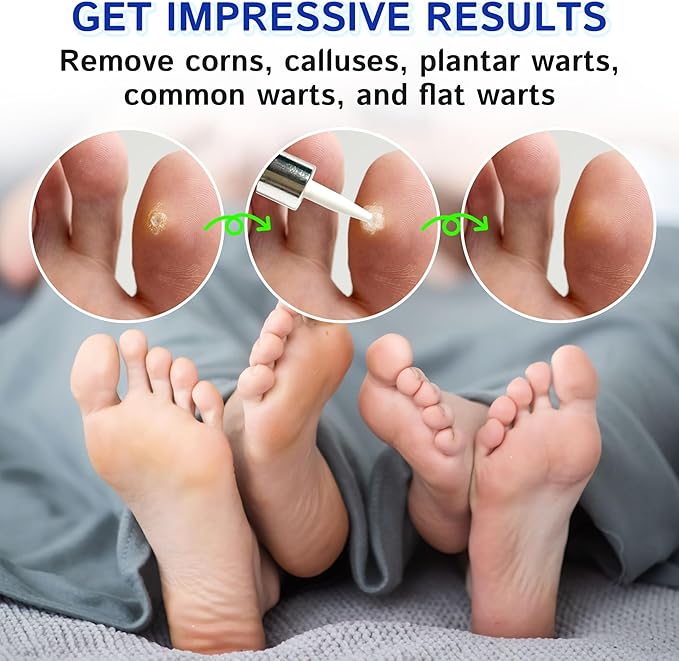 Ulensy Corn Remover Liquid for Toes Feet: 20ml Salicylic Acid for Foot Corns Calluses Wart Removal at Work Home - Safe for Kids Teens Adults Seniors Athletes Runners Workers Men Women