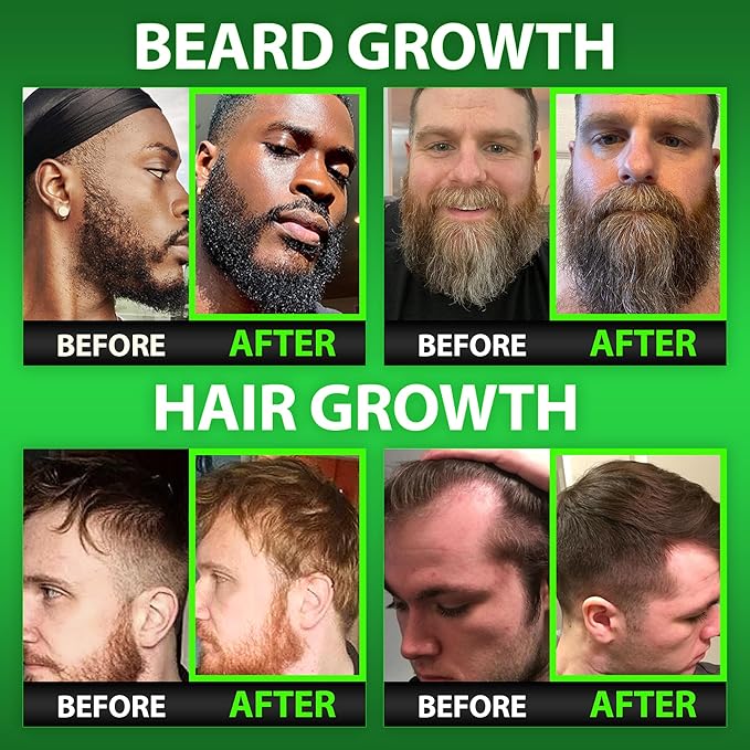 Biotin Beard Balm + Biotin Gummies – Beard Growth Kit with Conditioner & Softener for Fuller Thicker Beard & Hair – 620,000mcg Biotin, Collagen, MSM & Keratin for Healthy Hair Growth