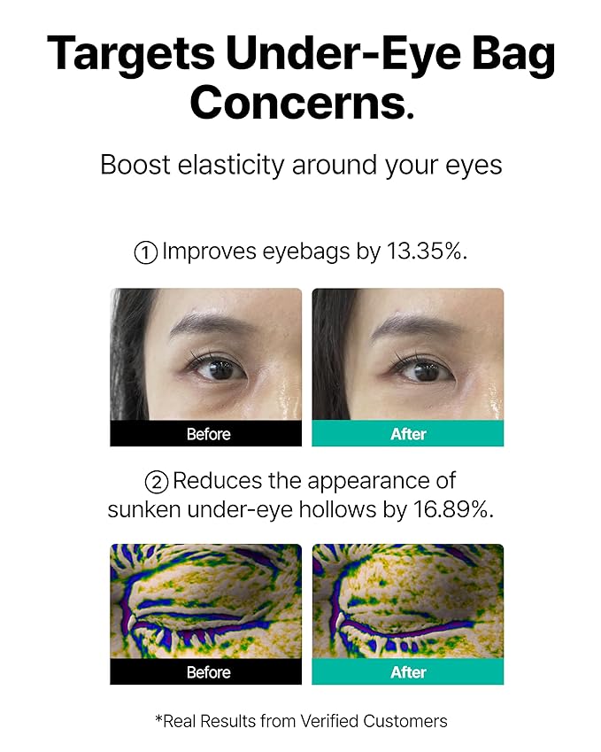 CHARDE 1100 Dissolvable Micropoints Eye Patch - Under Eye Patches for Puffy Eyes & Dark Circles - Korean Eye Mask for Appearance of Eye Bag Lift & Hydration - Cooling Under Eye Gels, 4 Pairs