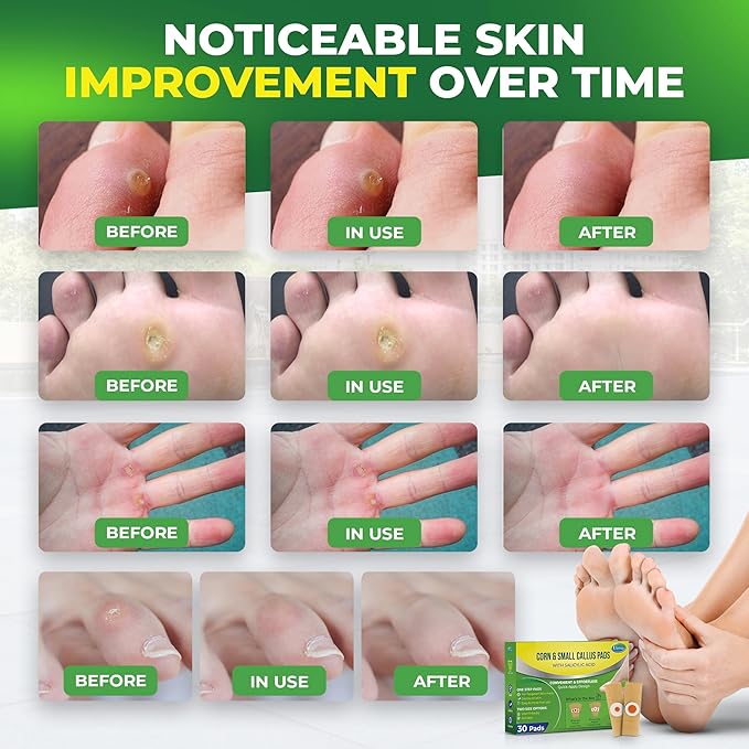 Corn Remover Pads for Feet Toes: 30-Pack Salicylic Acid Extra Strength Treatment - Fast Effective Medicated Bandages for Kids Adults Seniors Teens Athletes Runners Hikers Workers Men Women
