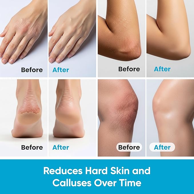 Miratiful Urea Cream 40% w 2% Salicylic Acid (4 oz) | Softens Cracked Heels & Dry Skin Urea Salicylic Acid Cream w/Tea Tree & Coconut Oil | Urea 40 Cream for Callus & Corn Treatment