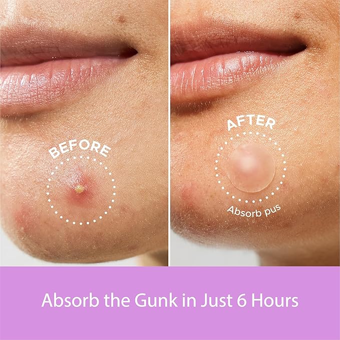 Wali Acne Patch with Tea Tree and Hydrocolloid, 72 Patches, 8mm and 12mm Sizes, Gentle for All Skin Types, Absorbs Secretions