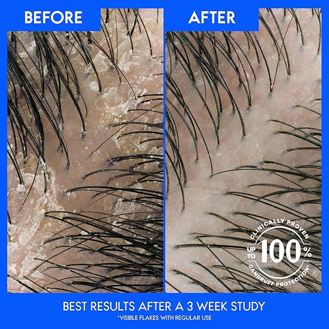 Head & Shoulders Anti-Dandruff Shampoo and Conditioner, with Eucalyptus for Itchy Scalp Care 2-in-1 Twin Pack, 1% Pyrithione Zinc, Flake Control and Refreshed Scalp, 32.1 fl oz Each